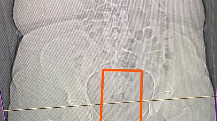 Midesinden 21,39 gram uyuşturucu çıktı