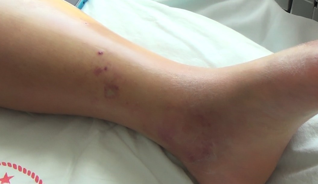 Tunceli’de koca engerek yılanının ısırdığı kadın, tedavi altına alındı