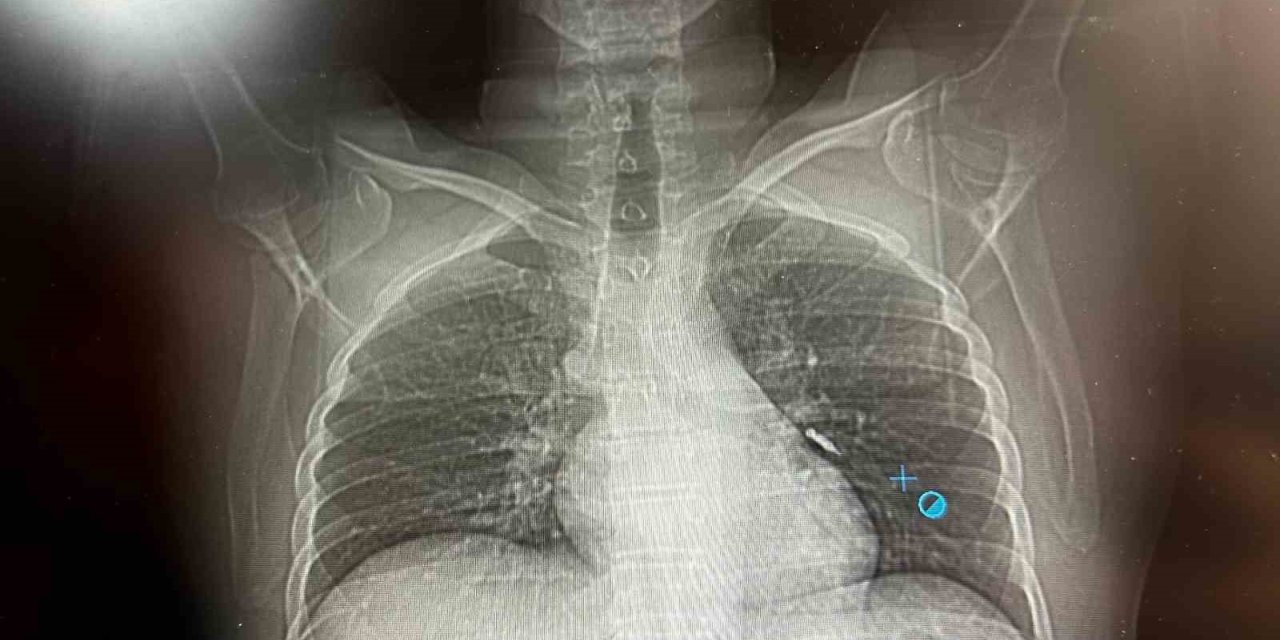 İmplant vidası ciğerine kaçan hasta ölümden döndü