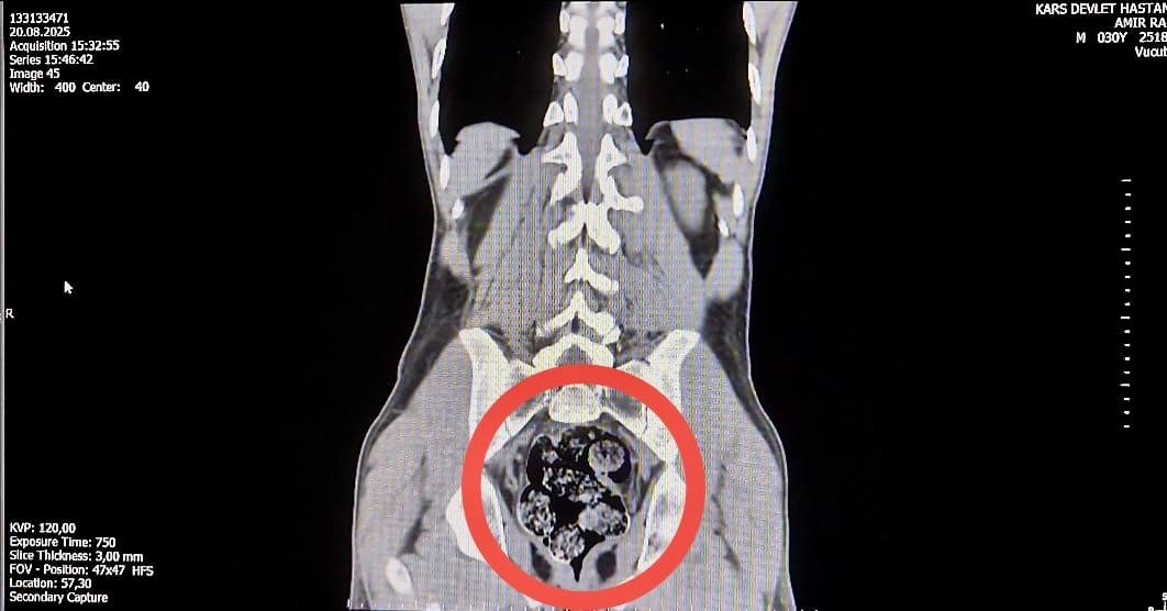 Kars’ta İranlı kuryenin makatından uyuşturucu çıktı
