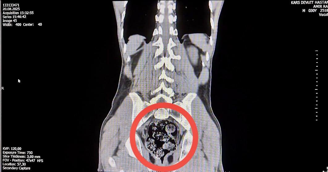 Makatında uyuşturucu saklamış