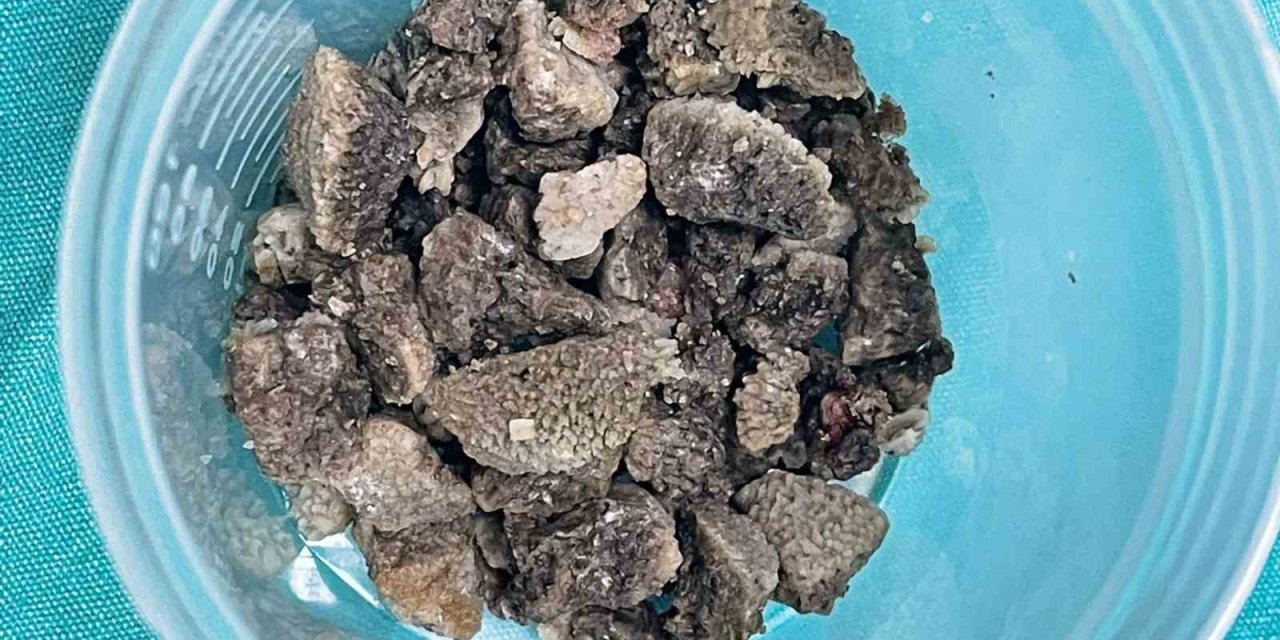8 santimetrelik ’geyik boynuzu’ böbrek taşı kapalı yöntemle çıkarıldı