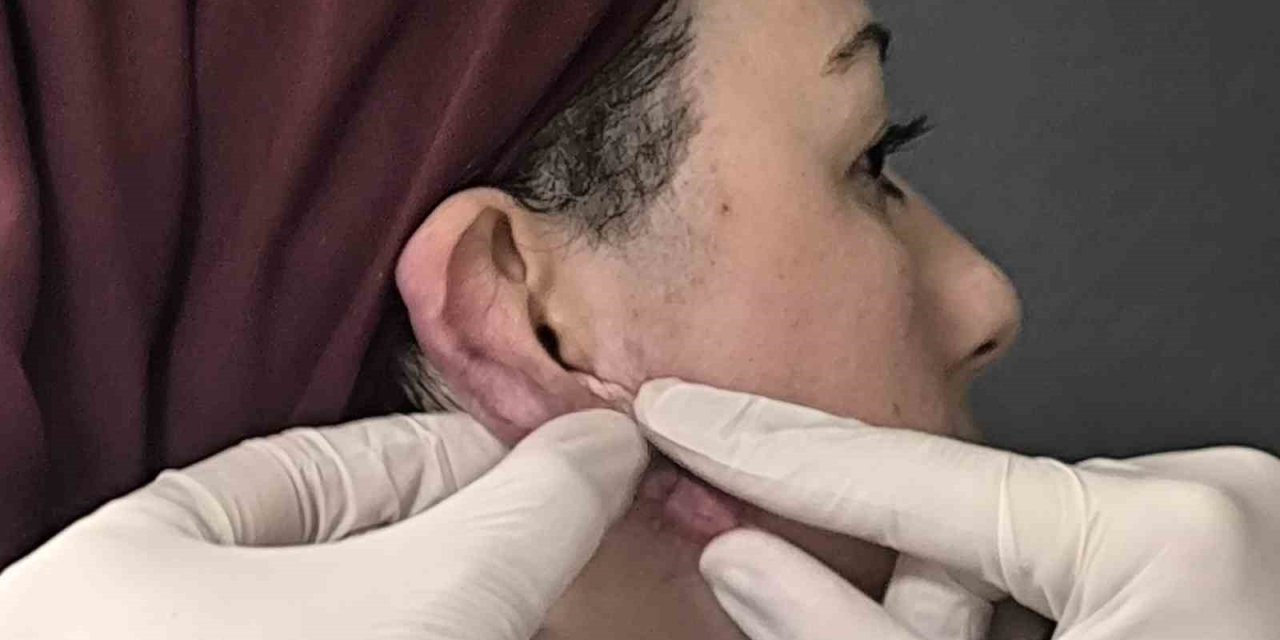 Muş’ta bir ilk: Kulak keloidi, ödüllü cerrahi teknikle tedavi edildi