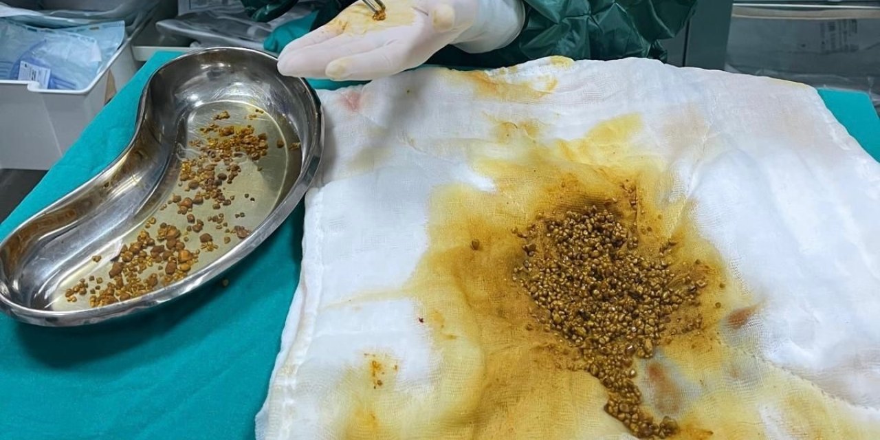 Bingöl’de nadir vaka: Safra kesesinden 2 bin 67 taş çıkarıldı