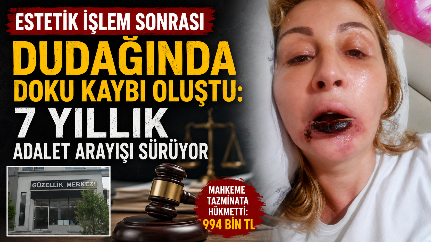 Estetik İşlem Sonrası Dudağında Doku Kaybı Oluştu: 7 Yıllık Adalet Arayışı Sürüyor