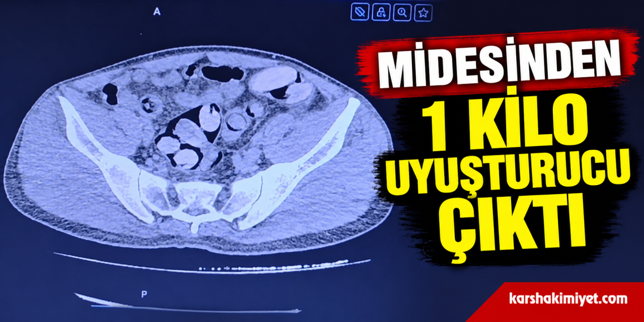 Midesinden 1 kilo uyuşturucu çıktı