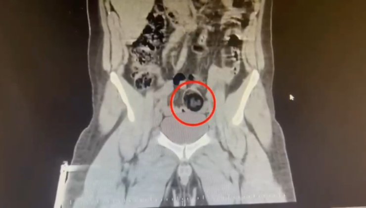 Kars’ta İranlı kuryenin makatından uyuşturucu çıktı