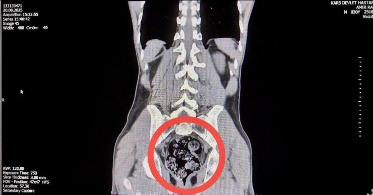 Kars’ta İranlı kuryenin makatından uyuşturucu çıktı