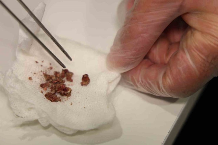 Elazığ’da estetik ameliyatta şaşırtan olay, burundan taş çıktı